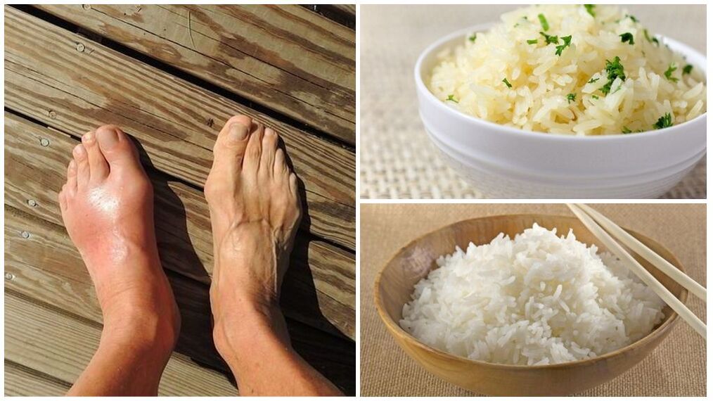 Una dieta a base di riso è consigliata per i pazienti con gotta. 